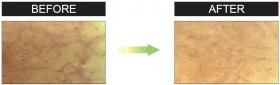 Liporeductyl® Before After