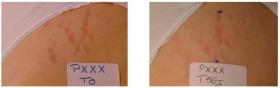 Regestril before after