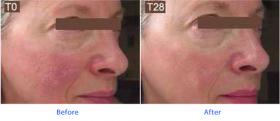 Renovage Sederma Before - After