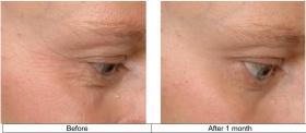 Subliskin™ Before After