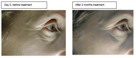 Dermaxyl before after