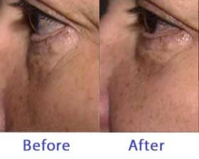 Eyeliss Before After