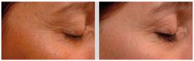 Syn®-Tacks Before / After 56 days of treatment 