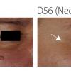 Neomatrix Before After