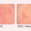 Neutrazen™ before after