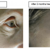 Dermaxyl before after