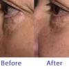 Eyeliss Before After
