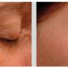 Syn®-Tacks Before / After 56 days of treatment 